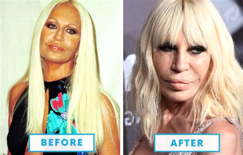 top 10 worst plastic surgeries.